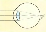 В спокойном состоя­нии фокус оптической системы здорового глаза расположен на сетчатке