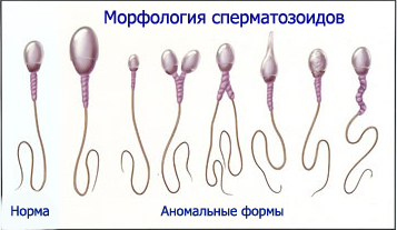 нарушения морфологии сперматозоида.фото
