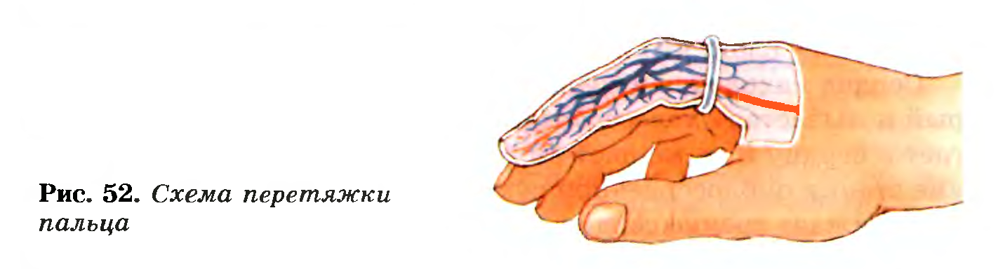 Схема перетяжки пальца
