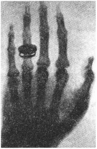 Рентгеновський знимок кисті людини. фото